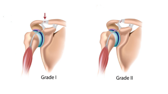 Grade 1 Grade 2 Tear